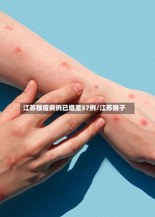 江苏猴痘病例已增至57例/江苏猴子