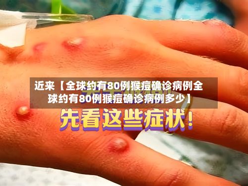 近来【全球约有80例猴痘确诊病例全球约有80例猴痘确诊病例多少】-第2张图片